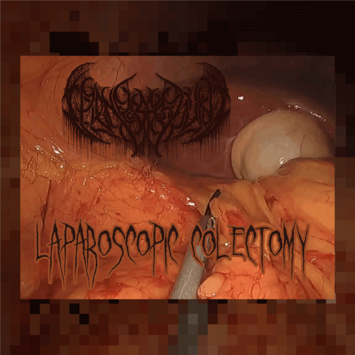 Open Flesh Wound : Laparoscopic Colectomy
